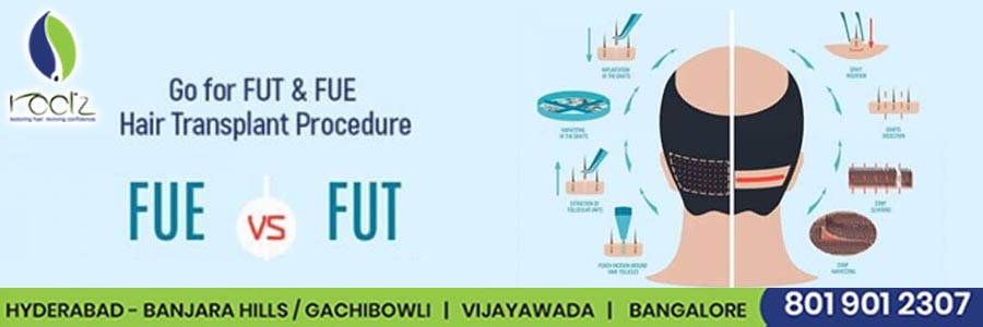 FUT  FUE  Which method is best